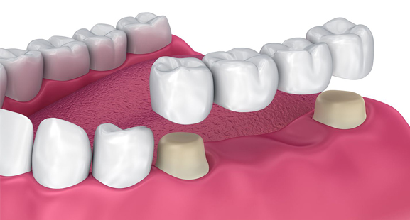 3D dental model showing tooth implant procedure with missing tooth replacement in gum tissue.