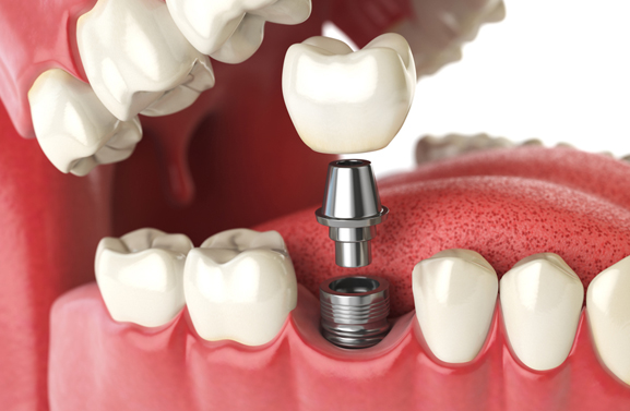Dental implant model showing tooth crown placement on titanium post with surrounding teeth.