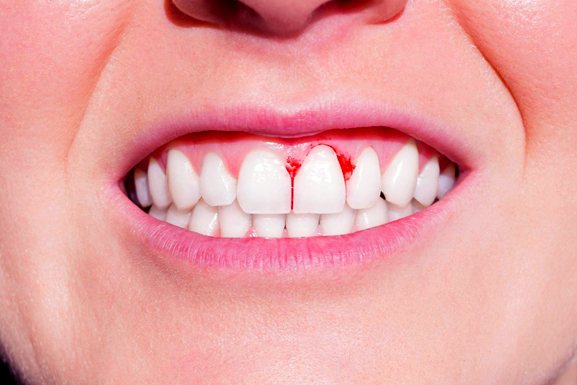 Close-up of person's smile showing bleeding gums between front teeth, indicating gum disease or poor oral health.