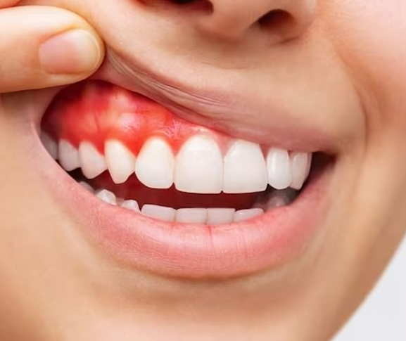 Person smiling showing inflamed gum area highlighting dental health concern and treatment need.