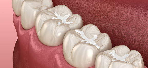 Dental crowns illustration showing porcelain tooth restorations on gum model displaying dental work.